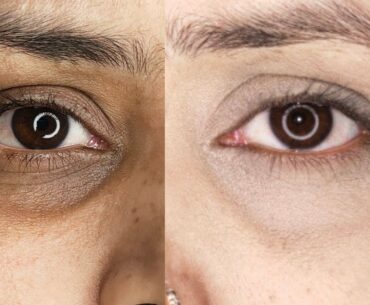 How To Remove Dark Circles Naturally At Home Quickly