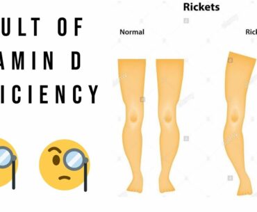 Vitamin D deficiency cause Rickets Sources of Vitamin D.