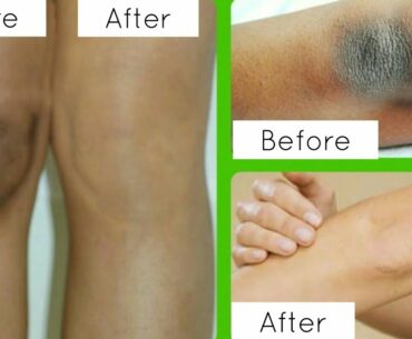 How To Lighten Dark Elbows, Knees & Underarms with Vitamin E Oil