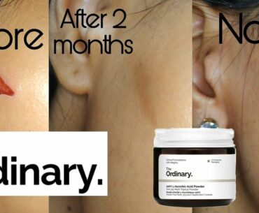 5 Month Update on The Ordinary 100% Lascorbic Acid Powder | Answering your questions