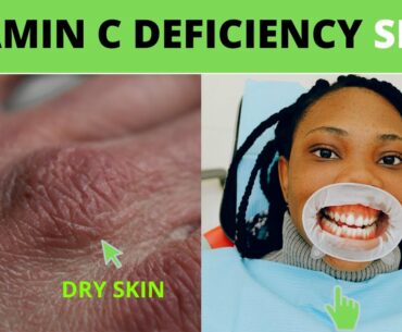 Vitamin C Deficiency 7 signs and symptoms