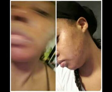 Best ACNE Product Ever! | RestOviebelle