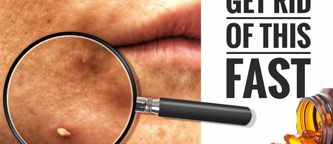 DIY Blemish Spot Treatment With Tea Tree Oil And Vitamin E