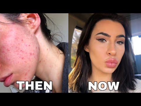 HOW TO REALLY GET RID OF ACNE FAST!