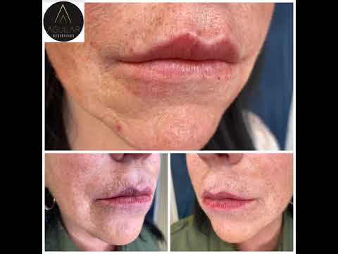 Lip Augmentation: Second session