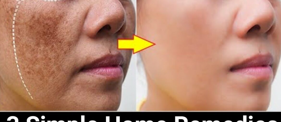 Remove Face Pigmentation Naturally. 100% Effective