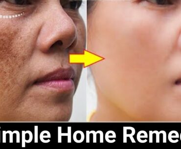 Remove Face Pigmentation Naturally. 100% Effective