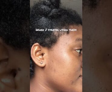 Before and After 1 month of using Chuarme Hydrating Mist Coco Oil X Rose Vitamin C 2 in 1 MASK
