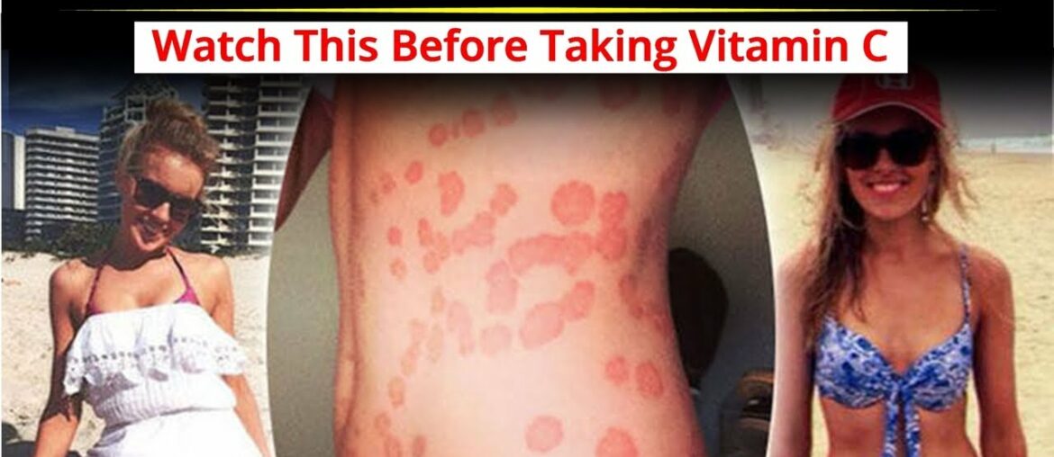 Is Vitamin C Good for Psoriasis - Watch This Before Taking Vitamin C