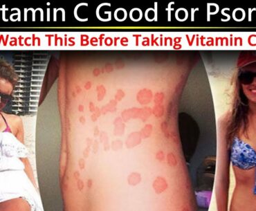 Is Vitamin C Good for Psoriasis - Watch This Before Taking Vitamin C