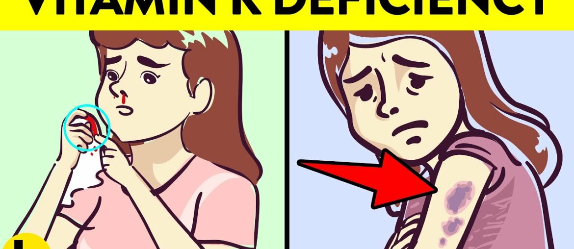 12 Hidden Signs You Have Vitamin K Deficiency