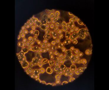 Blood Type and COVID-19: There May Be Something Here