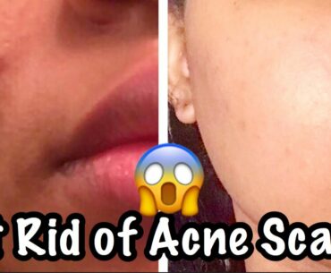 How to Get Rid of Acne Scars: TruSkin Naturals Vitamin C Serum