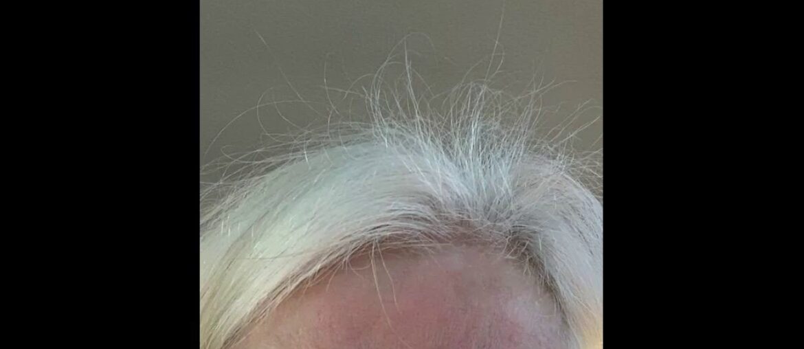 Advanced Collagen Supplement, Type 1, 2 and 3 with Hyaluronic Acid and Vitamin C - Anti Aging J...