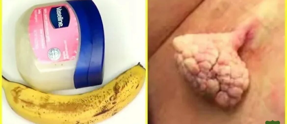 HOME REMEDY HOW TO  Remove skin TAGS EASILY AT HOMES,JUST 3 INGREDIENTS, RESULT AFTER 1 NIGHT