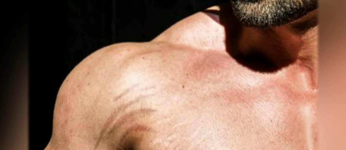 Stretch Marks Remove Permanently Naturally and Supplements Creams and Oils