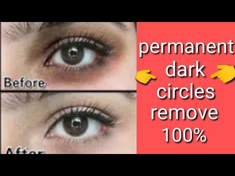 Dark circles remove in 3 days|| vitamin E-capsule (100%)working