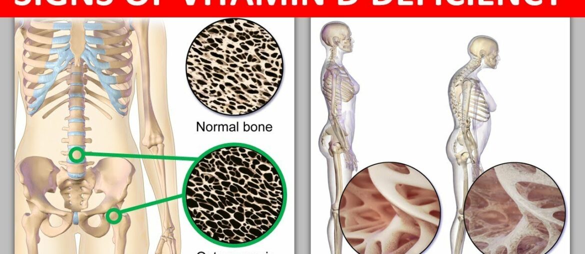 Warning Signs of Vitamin D Deficiency