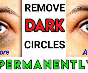 Remove Dark Circles Permanently | 100% working | Home Remedies