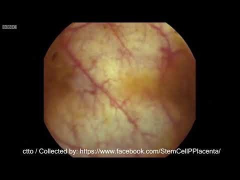 STEM CELL THERAPY, Boost Immune System to fight Covid-19