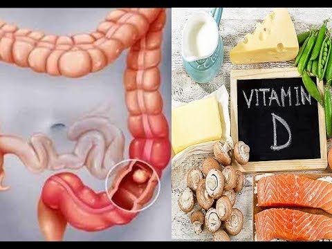 Higher vitamin D levels cut colorectal cancer risk by 31%