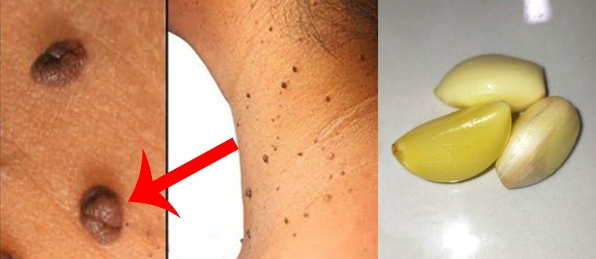 How to remove skin tags naturally fast with garlic and vitamin - Remove skin tags