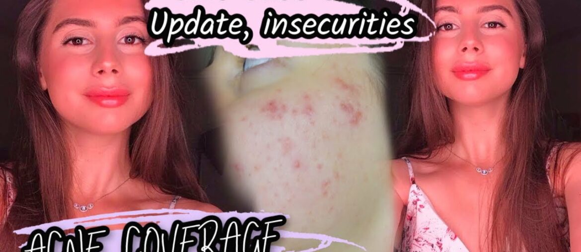 MY NO FOUNDATION MAKEUP ROUTINE || Chit Chat skin issues, thoughts on accutane, confidence