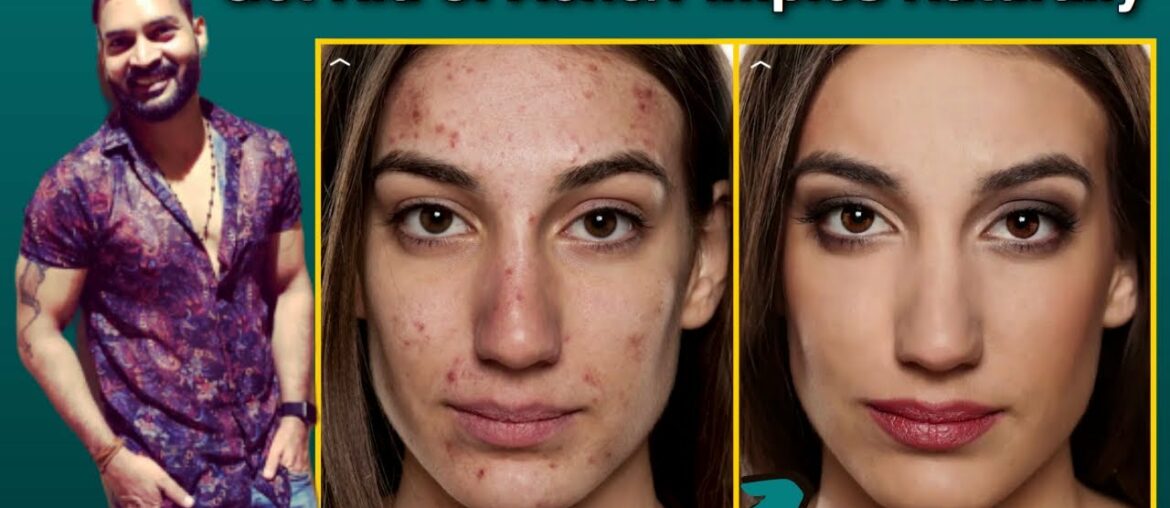 Get Rid of ACNE & PIMPLES NATURALLY FOREVER