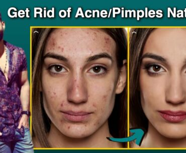 Get Rid of ACNE & PIMPLES NATURALLY FOREVER