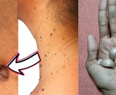 How to remove skin tags naturally fast with Garlic and Vitamin-E | Remove skin tags at home