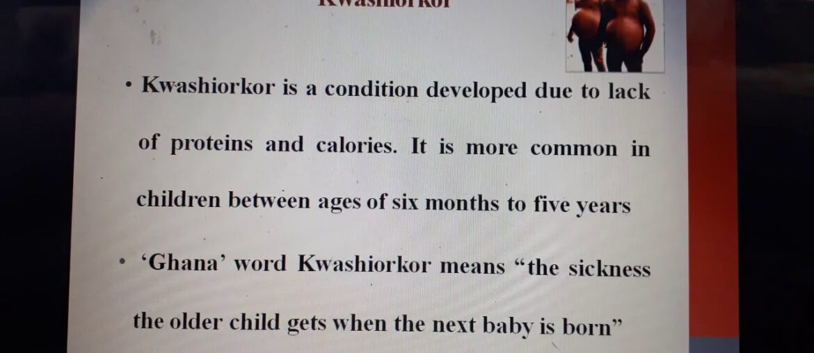 Protein Energy Malnutrition & Vitamin Deficiencies