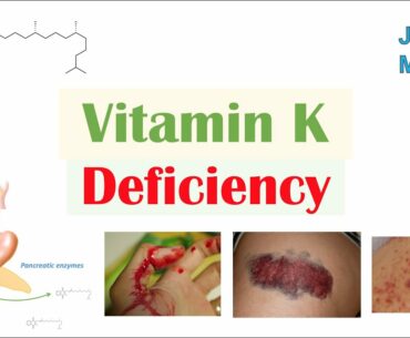Vitamin K Deficiency | Dietary Sources, Causes, Symptoms, Diagnosis, Treatment