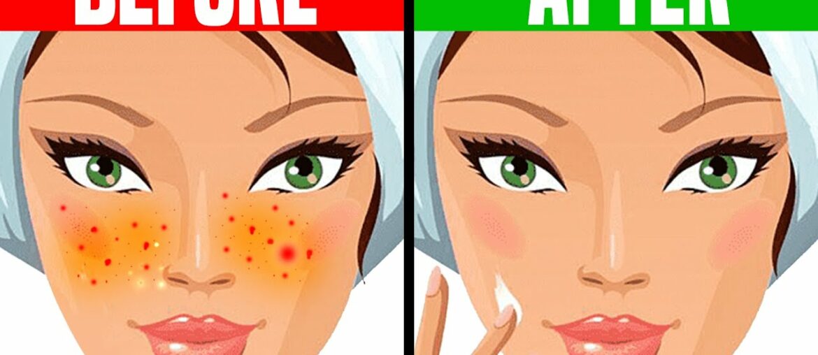 How to Get Rid of Acne OVERNIGHT