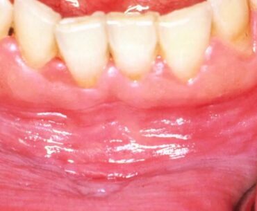 Getting The Health - Dietary supplements, Vitamins, Canker sore - Pinterest To Work