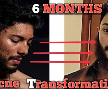 How to fight acne and get rid of it permanently || Isotretinoin || ACCUTANE  JOURNEY