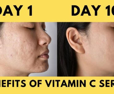 Benefits of Viatmin C serum|Vitamin C serum for glowing and acne free skin