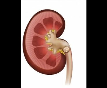 Can Vitamin D Supplements Cause Kidney Stones???