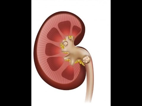 Can Vitamin D Supplements Cause Kidney Stones???
