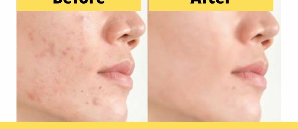 Foods/Vitamins/Minerals To Fight Acne