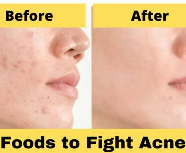 Foods/Vitamins/Minerals To Fight Acne