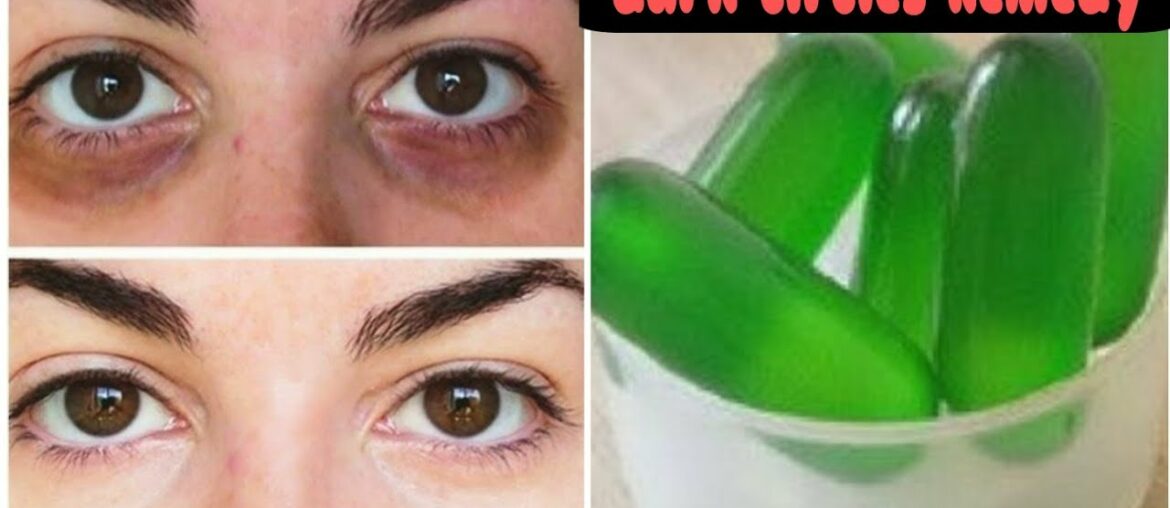 I used vitamin E capsules and get rid of dark circles in 3 days | Dark circles Remedy |