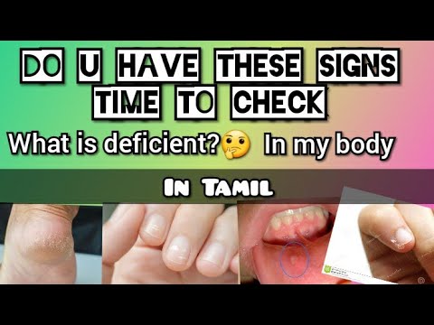 Signs that your body lacks vitamins | signs your body needs help | in Tamil | Miscellano