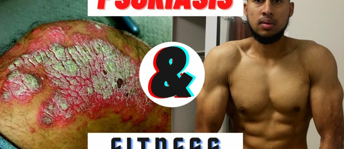 Psoriasis Bodybuilder Fitness Q and A