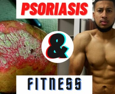 Psoriasis Bodybuilder Fitness Q and A