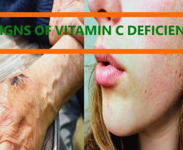 6 Signs of Vitamin C deficiency.
