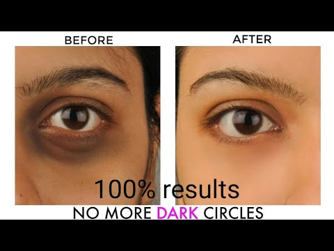 DIY.HOME REMEDY FOR DARK CIRCLE ||THE GIRL'S BEAUTY ICON