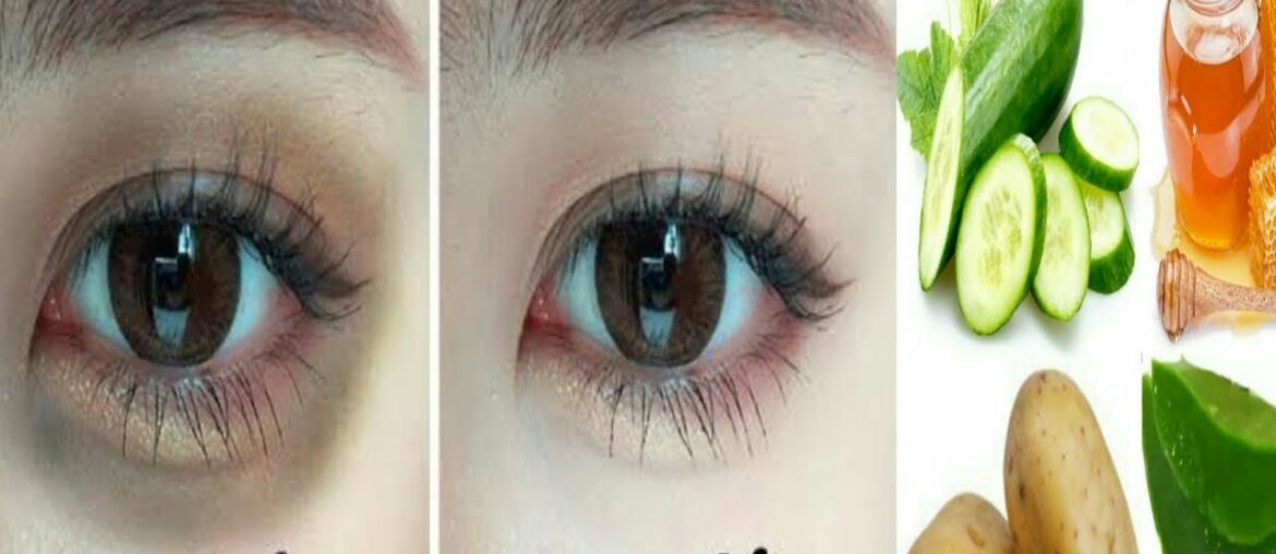 Remove Dark Circles Under Eyes Naturally in 5 Days With Potato, Aloe Vera & Vitamin E !