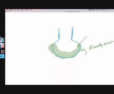 Is Hyaluronan In Bradykinin Storm Actually Observed In COVID-19 Patients? (YQA)