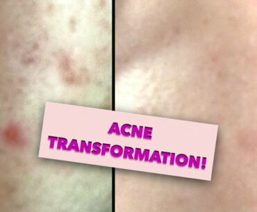 VITAMIN E SOAP  TRANSFORMATION TO PERMANENTLY CURE ACNE!
