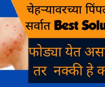 Best Acne Solution | How to Remove Pimples?